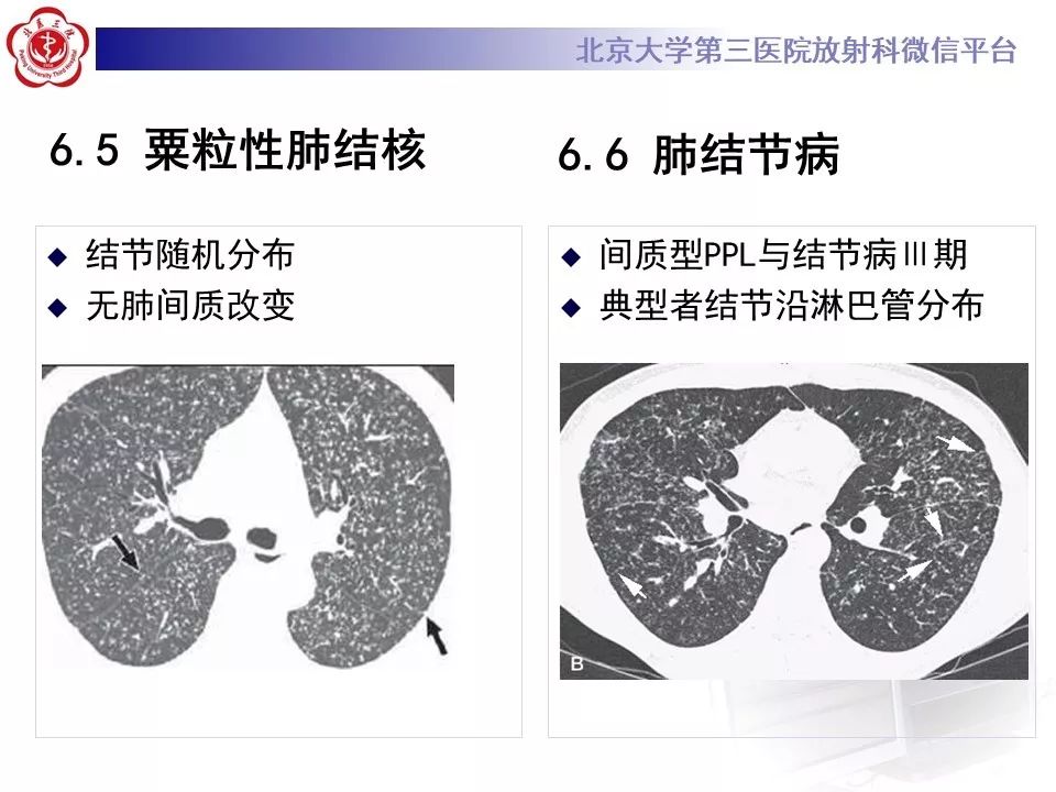 【病例】原发性肺淋巴瘤1例CT影像