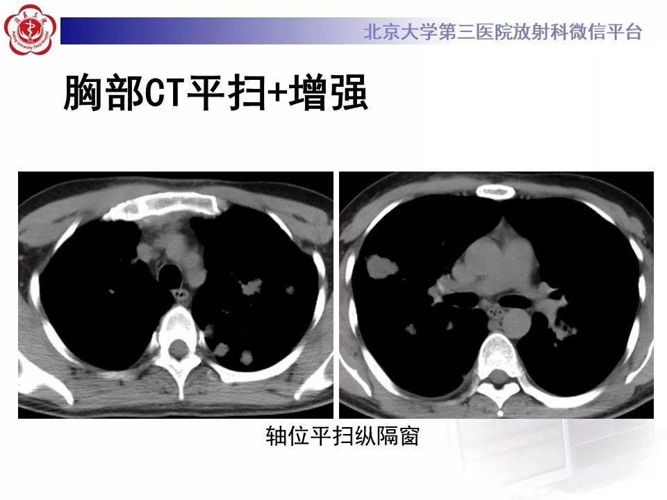 【病例】原发性肺淋巴瘤1例CT影像