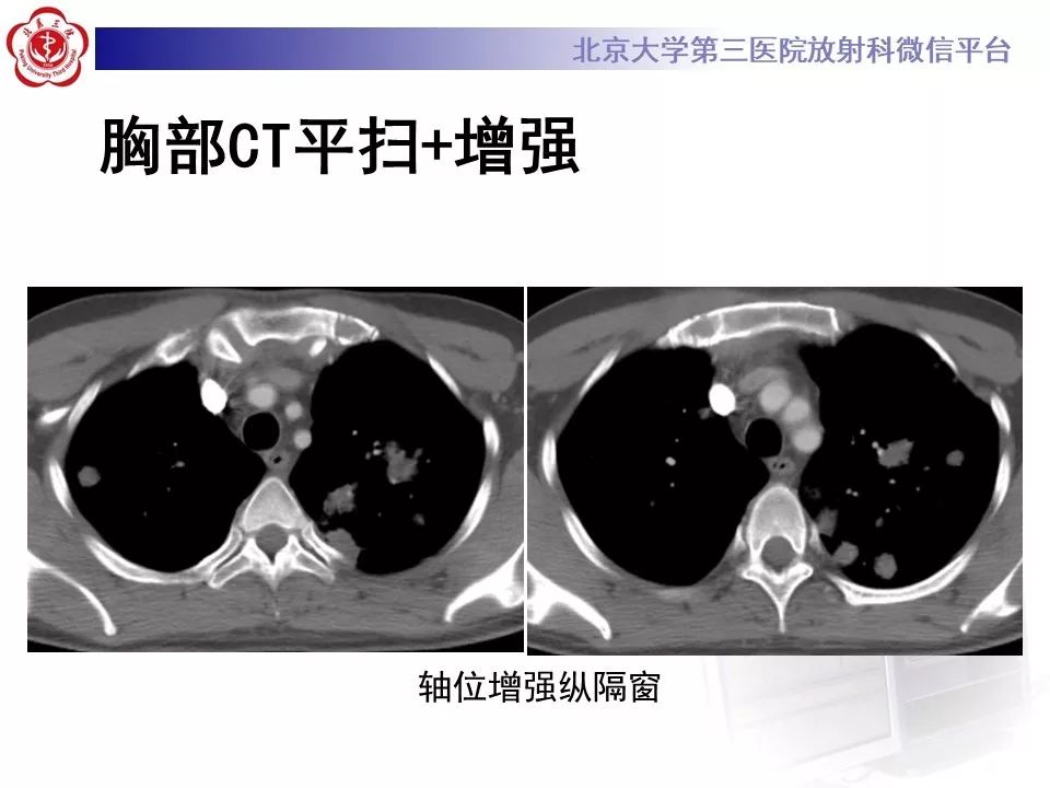 【病例】原发性肺淋巴瘤1例CT影像