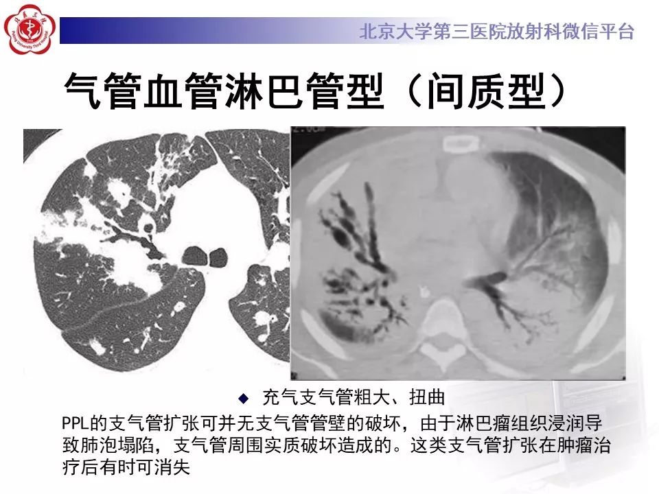 【病例】原发性肺淋巴瘤1例CT影像
