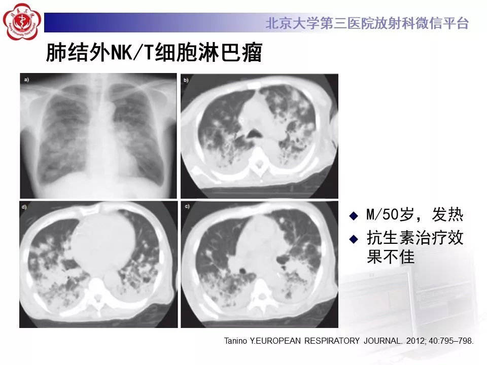 【病例】原发性肺淋巴瘤1例CT影像