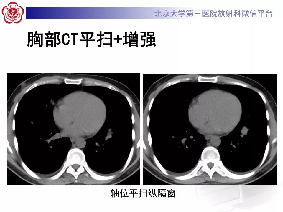【病例】原发性肺淋巴瘤1例CT影像