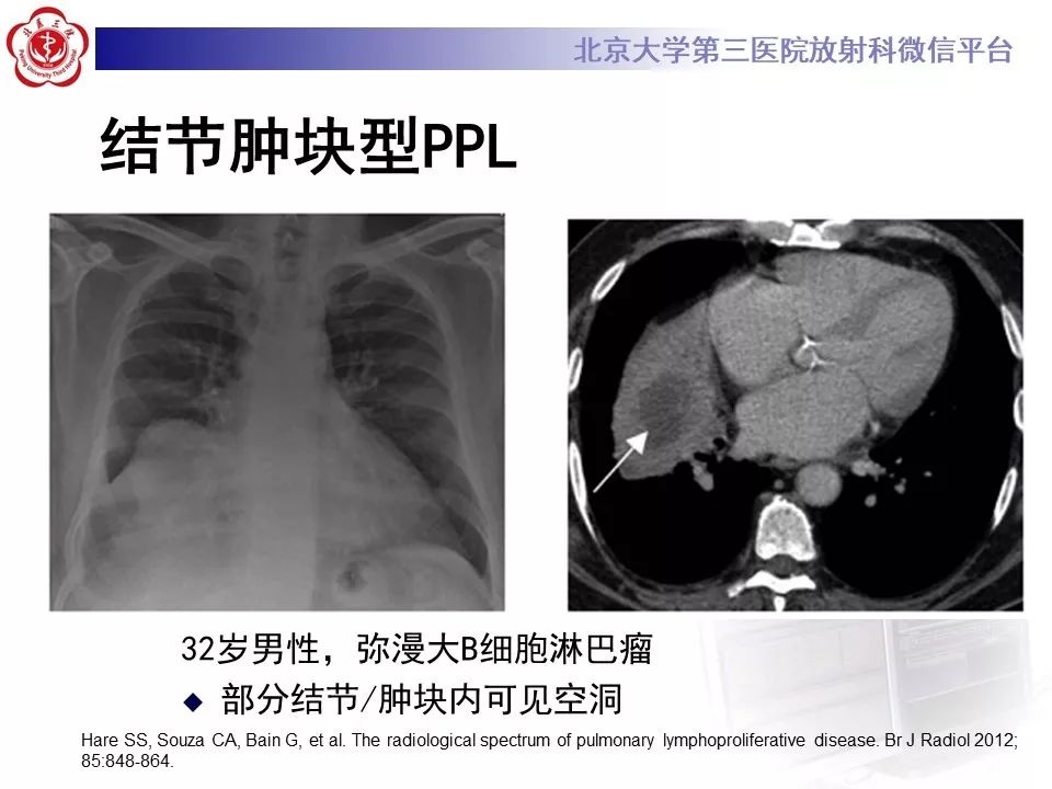 【病例】原发性肺淋巴瘤1例CT影像