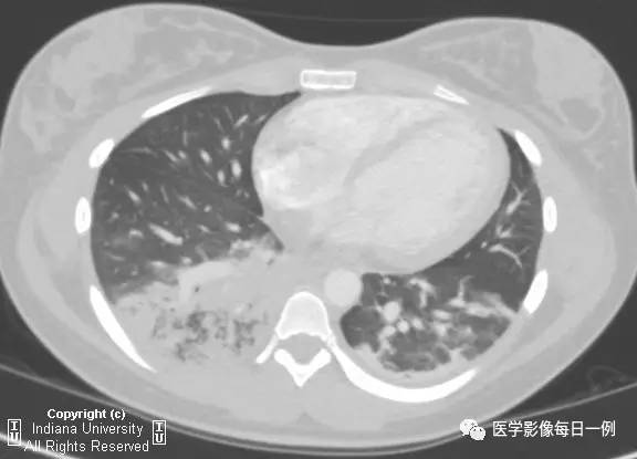 【病例】肺隔离症伴感染1例CT影像表现