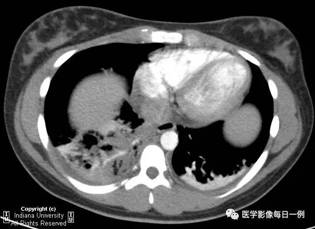 【病例】肺隔离症伴感染1例CT影像表现