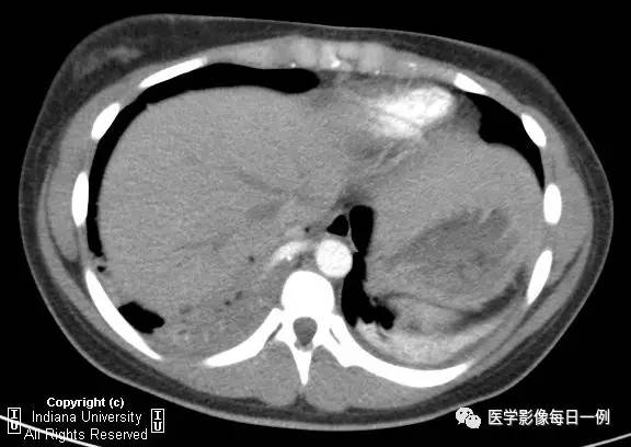 【病例】肺隔离症伴感染1例CT影像表现