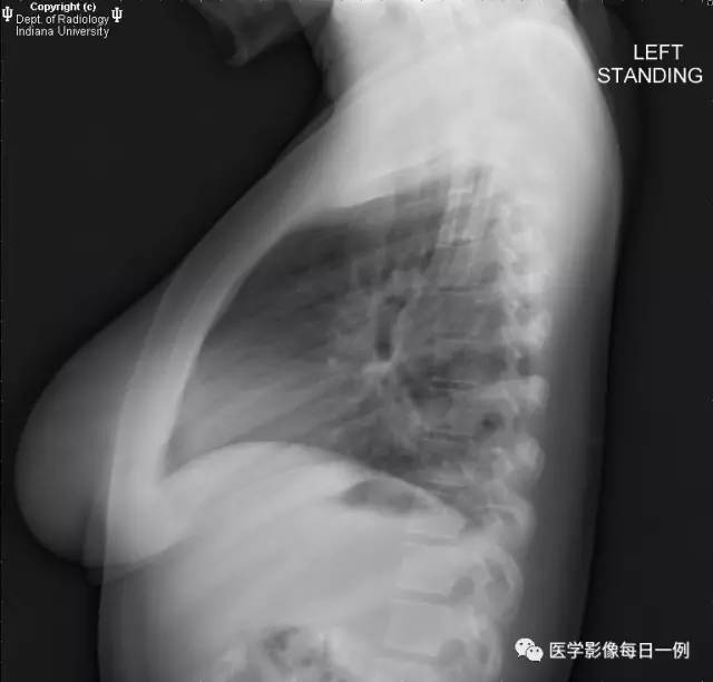 【病例】肺隔离症伴感染1例CT影像表现