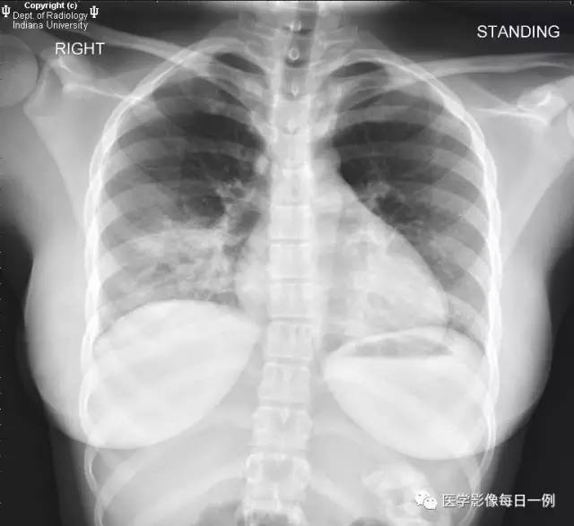 【病例】肺隔离症伴感染1例CT影像表现