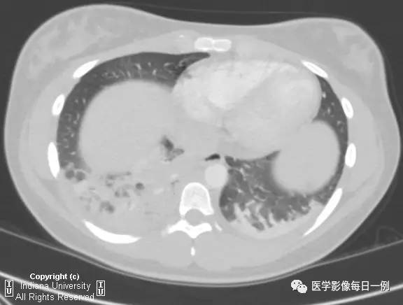 【病例】肺隔离症伴感染1例CT影像表现