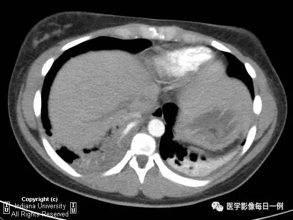 【病例】肺隔离症伴感染1例CT影像表现