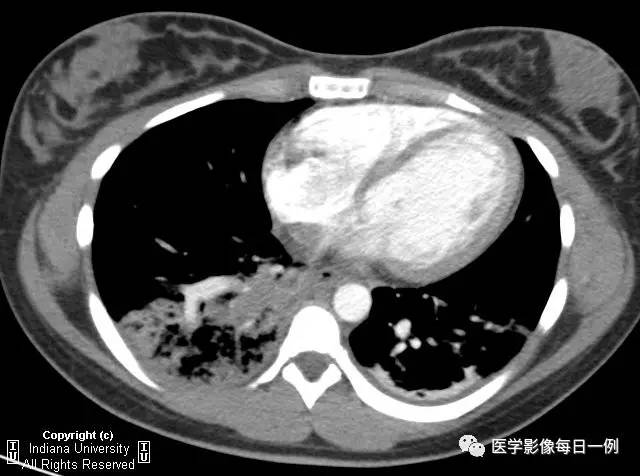 【病例】肺隔离症伴感染1例CT影像表现