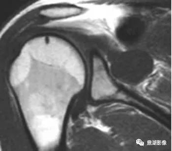 【病例】肩胛上神经卡压综合征1例MR