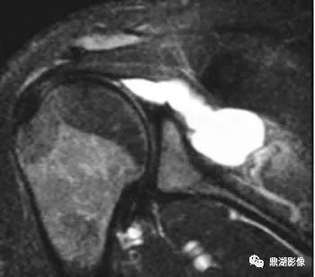【病例】肩胛上神经卡压综合征1例MR