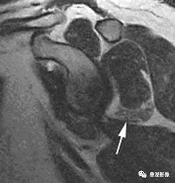 【病例】肩胛上神经卡压综合征1例MR