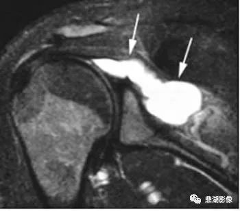 【病例】肩胛上神经卡压综合征1例MR