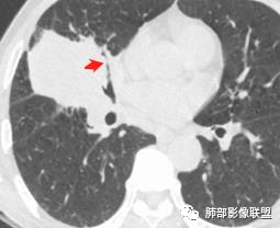 【病例】妖魔合体—你想不到的肉瘤样癌