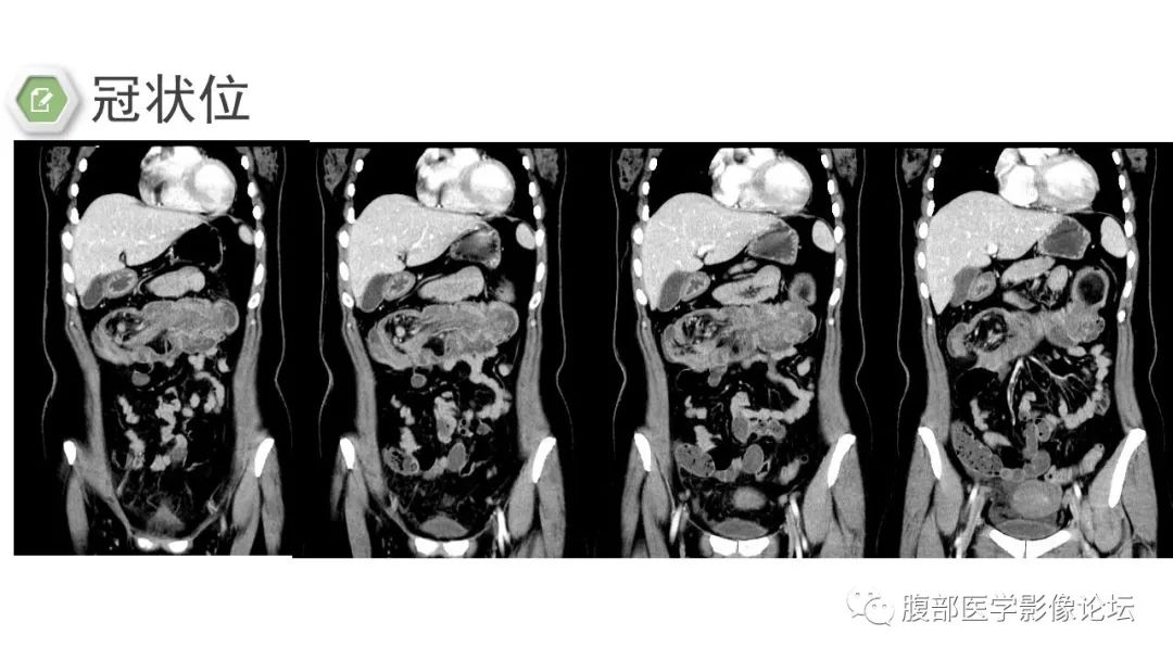 【病例】结肠脂肪瘤伴肠套叠1例CT
