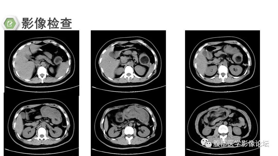 【病例】结肠脂肪瘤伴肠套叠1例CT