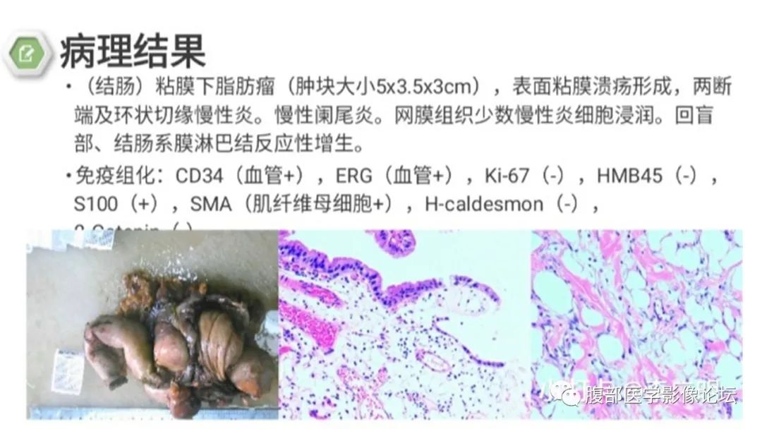 【病例】结肠脂肪瘤伴肠套叠1例CT