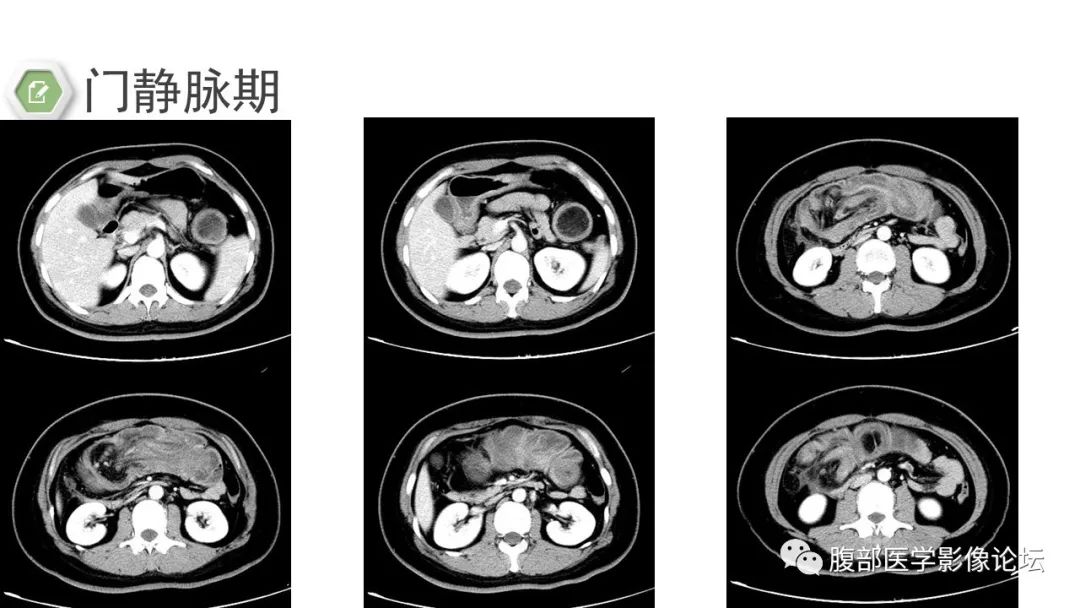 【病例】结肠脂肪瘤伴肠套叠1例CT