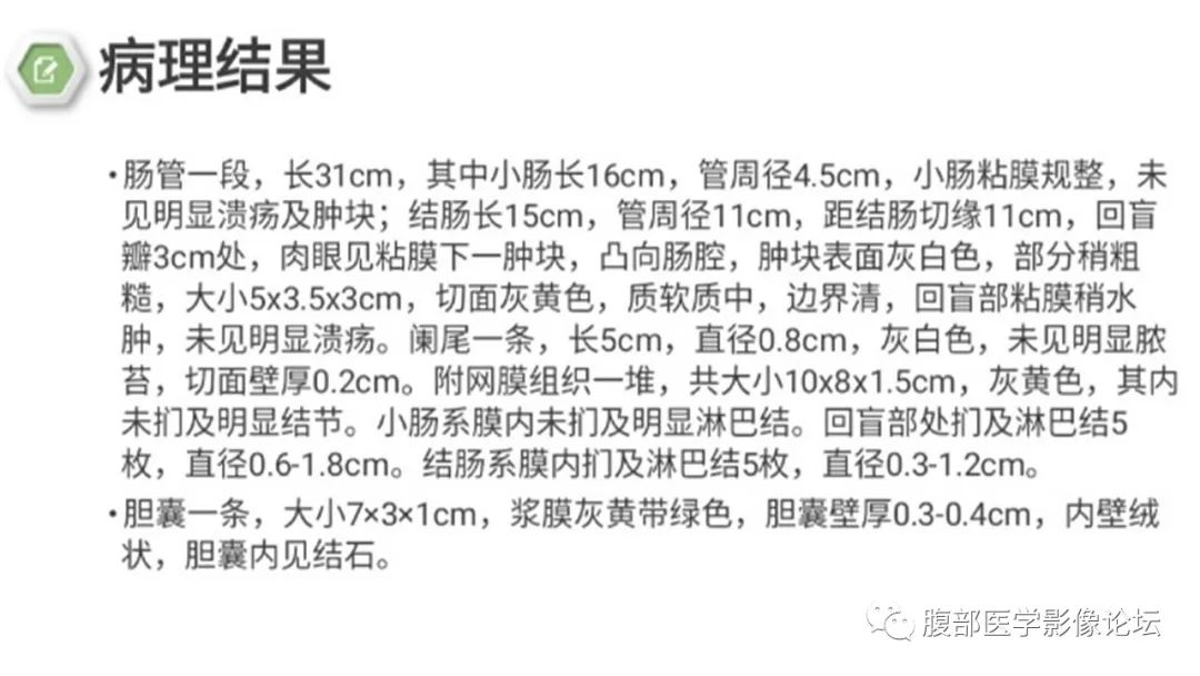【病例】结肠脂肪瘤伴肠套叠1例CT