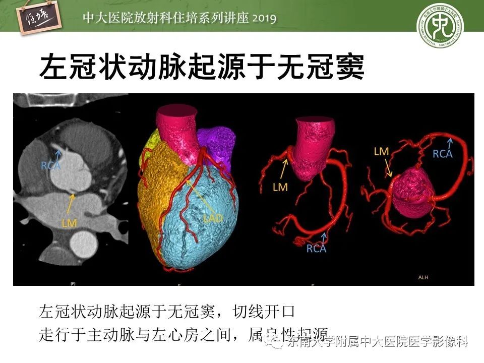 【PPT】冠状动脉CTA诊断流程