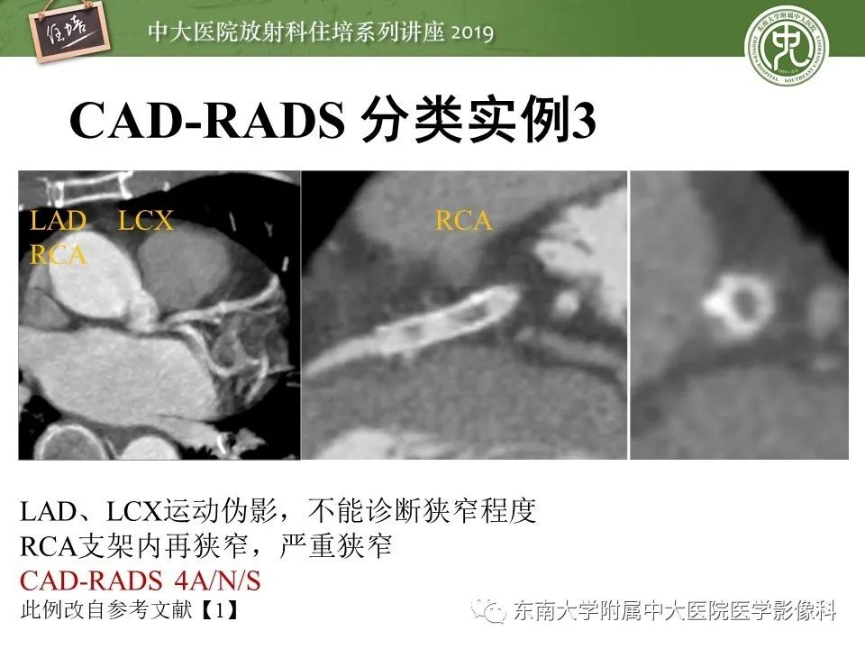 【PPT】冠状动脉CTA诊断流程