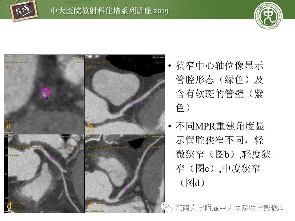 【PPT】冠状动脉CTA诊断流程