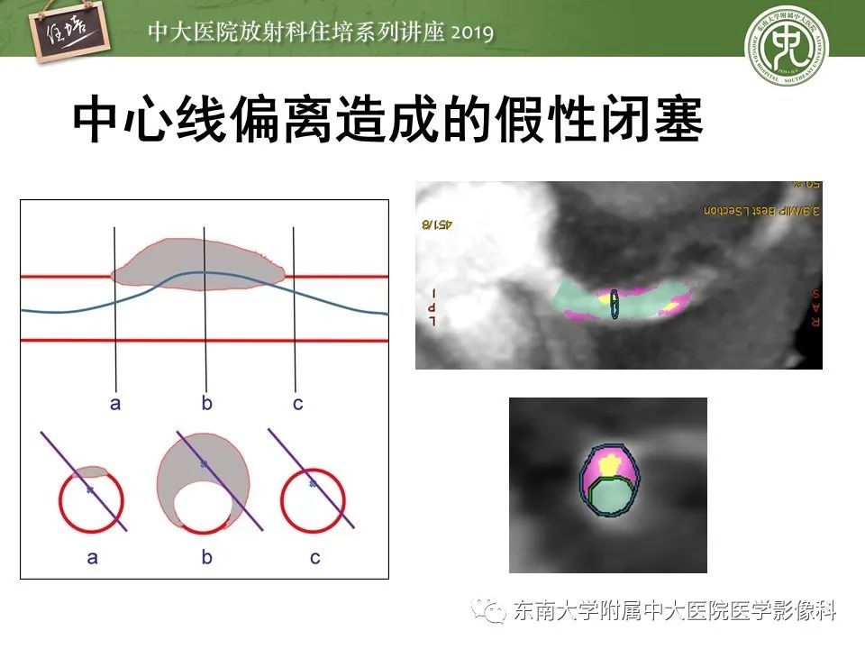 【PPT】冠状动脉CTA诊断流程