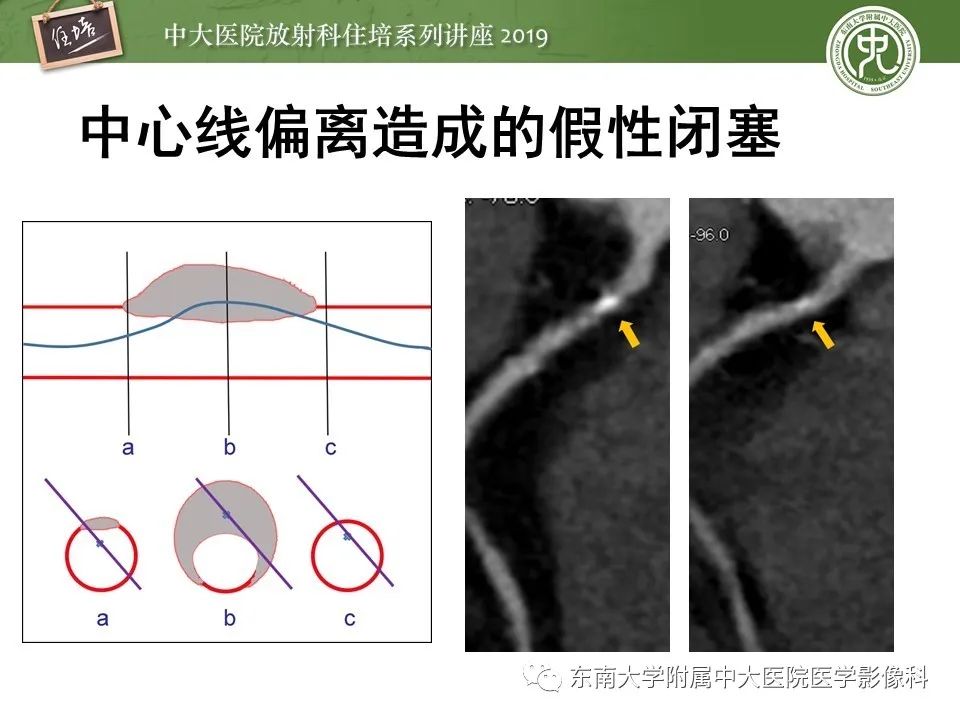 【PPT】冠状动脉CTA诊断流程