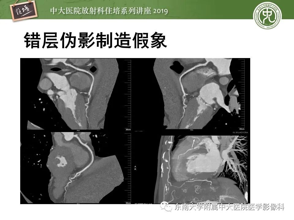 【PPT】冠状动脉CTA诊断流程