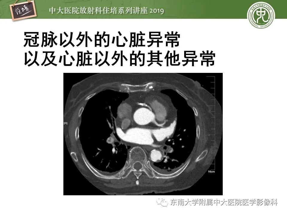 【PPT】冠状动脉CTA诊断流程