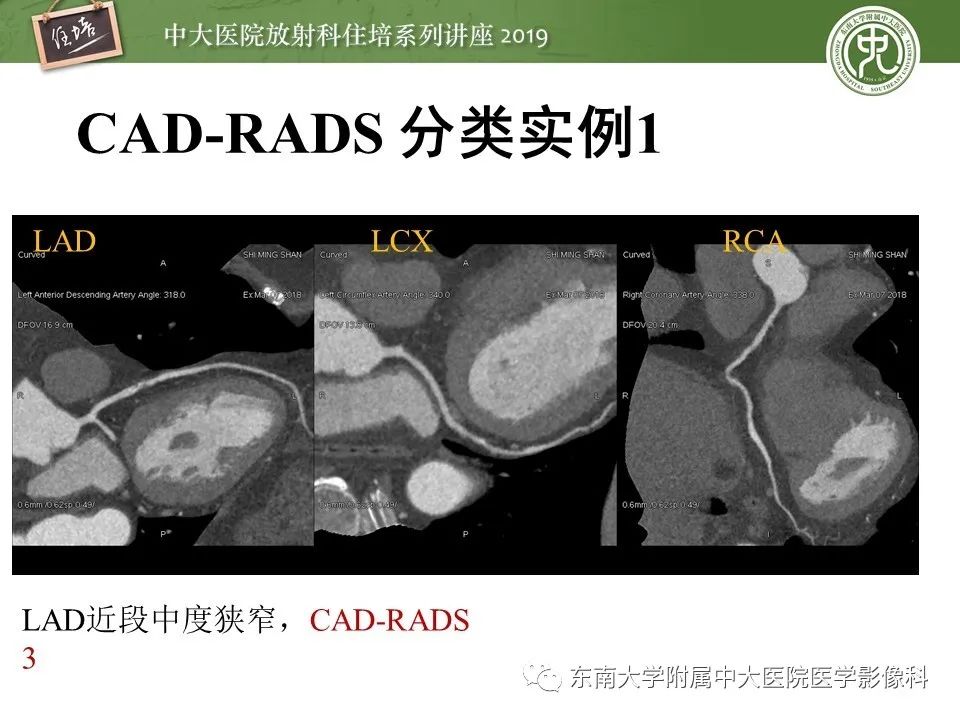 【PPT】冠状动脉CTA诊断流程