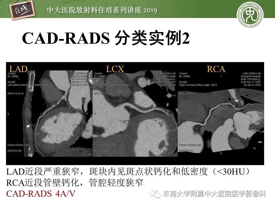 【PPT】冠状动脉CTA诊断流程