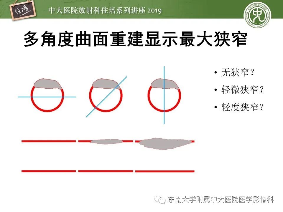 【PPT】冠状动脉CTA诊断流程