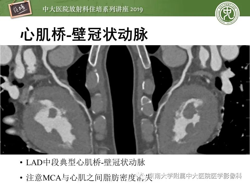 【PPT】冠状动脉CTA诊断流程
