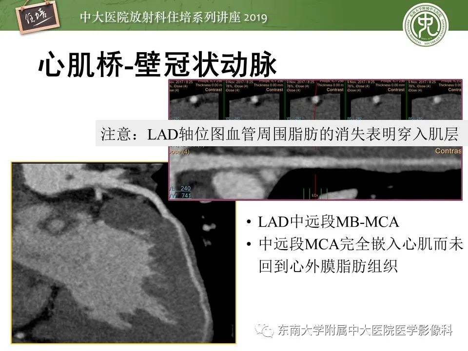【PPT】冠状动脉CTA诊断流程