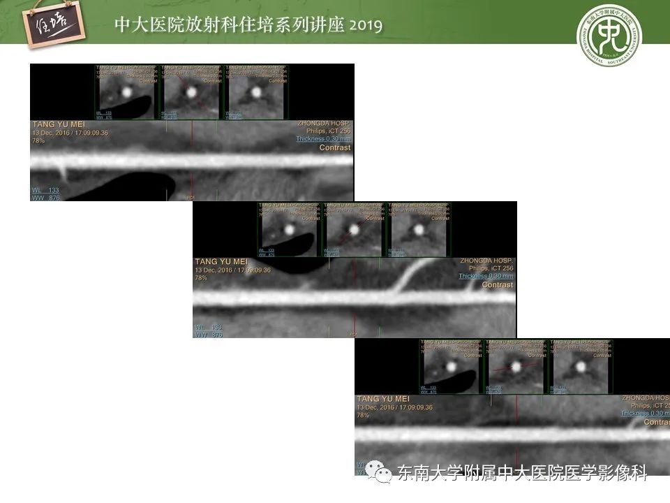 【PPT】冠状动脉CTA诊断流程