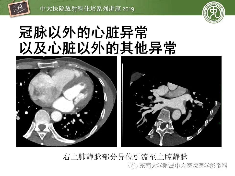 【PPT】冠状动脉CTA诊断流程