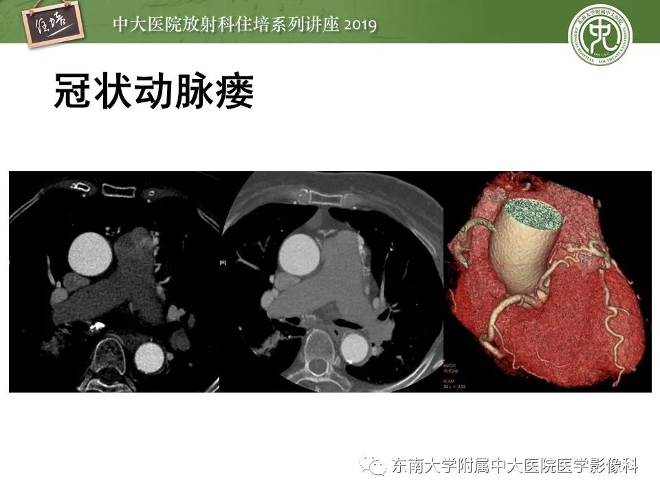 【PPT】冠状动脉CTA诊断流程