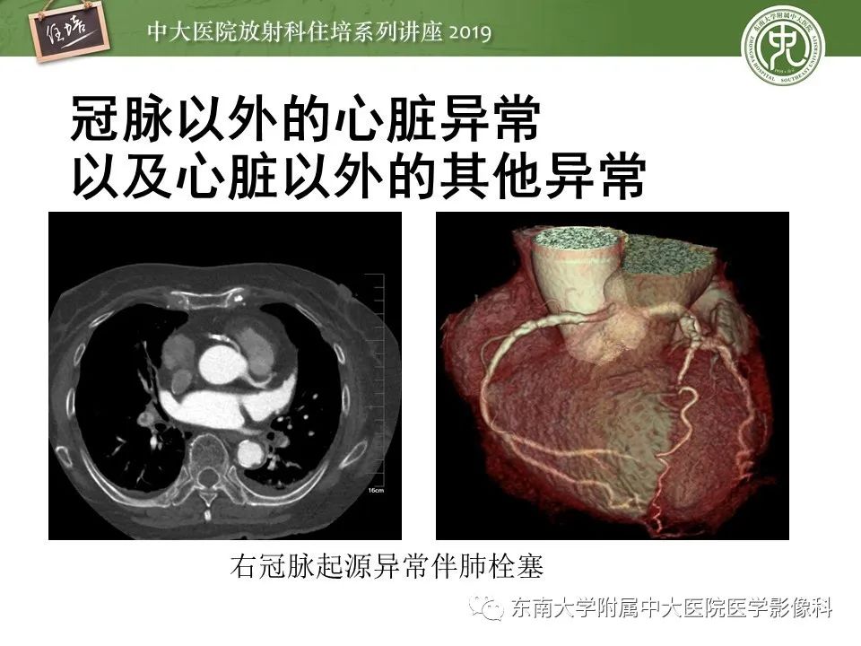 【PPT】冠状动脉CTA诊断流程