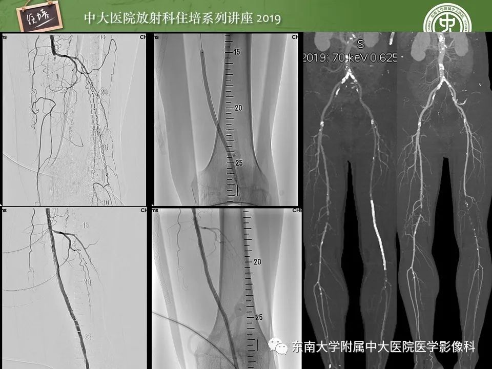 【PPT】下肢CTA的检查流程及评价