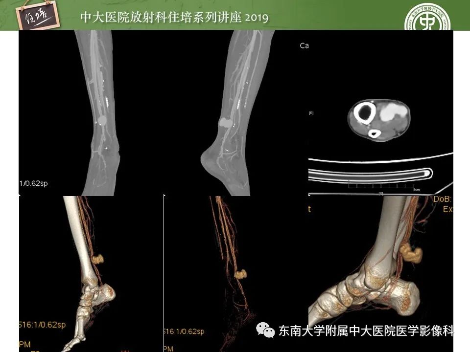 【PPT】下肢CTA的检查流程及评价