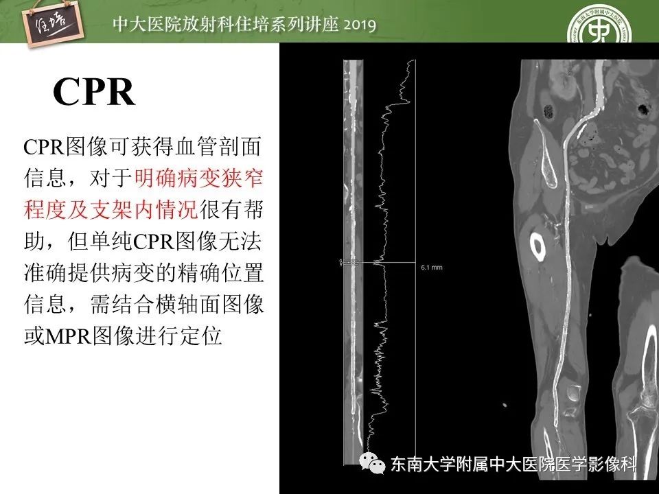 【PPT】下肢CTA的检查流程及评价
