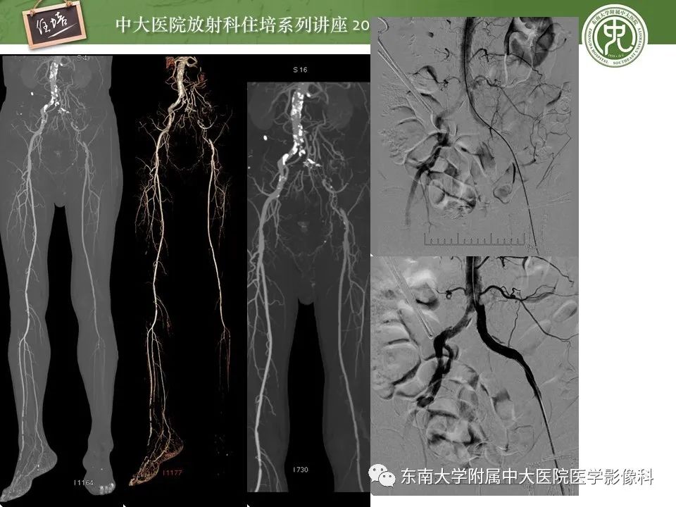 【PPT】下肢CTA的检查流程及评价