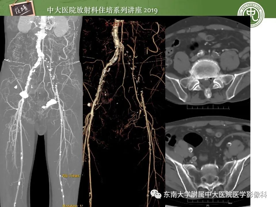 【PPT】下肢CTA的检查流程及评价