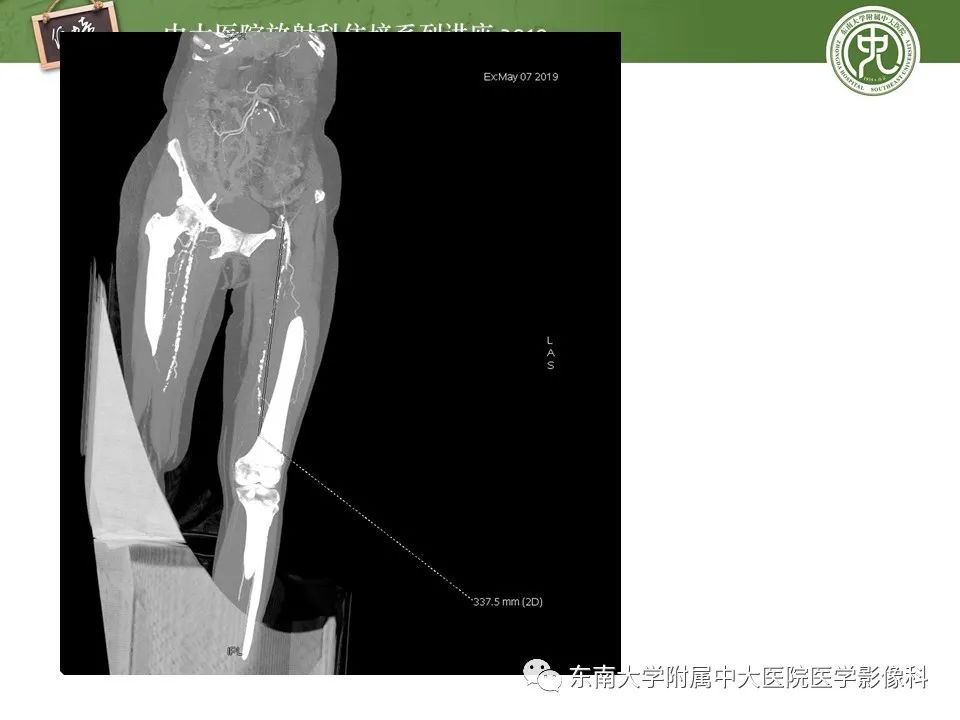 【PPT】下肢CTA的检查流程及评价