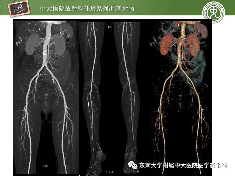 【PPT】下肢CTA的检查流程及评价