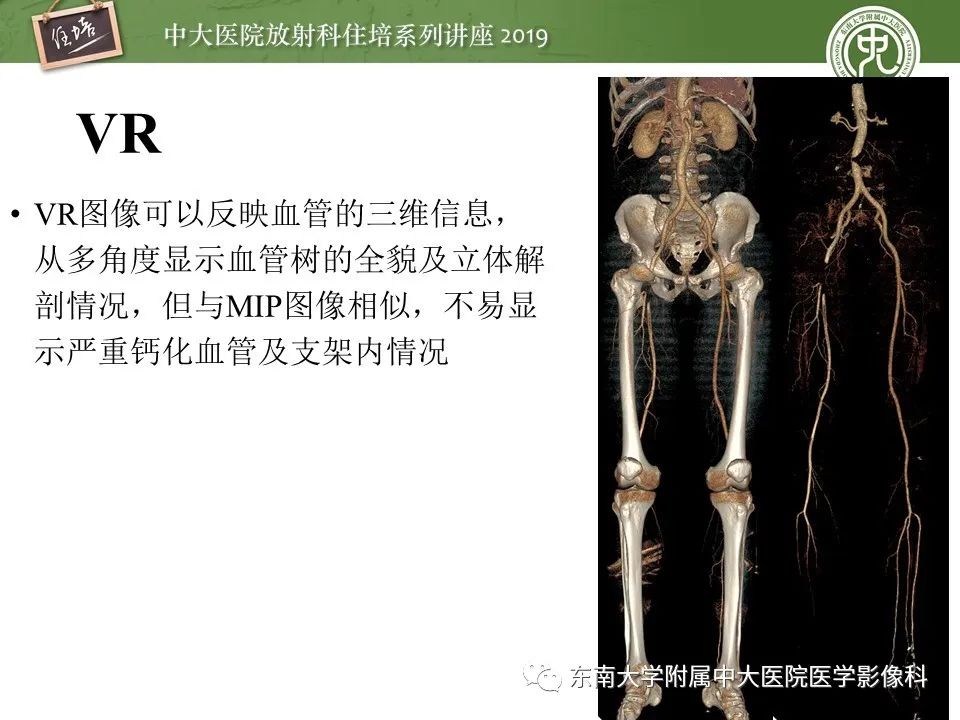 【PPT】下肢CTA的检查流程及评价