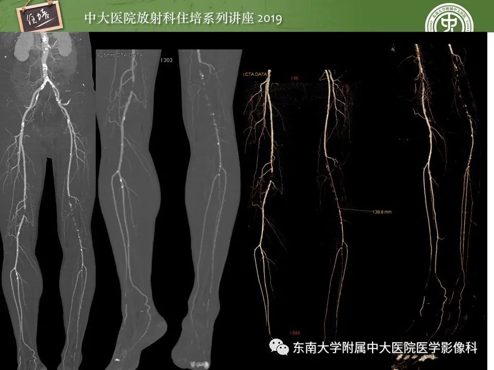【PPT】下肢CTA的检查流程及评价